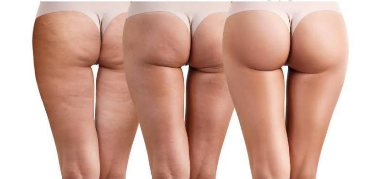 Curso de Preenchimento Glúteo (Injetável)