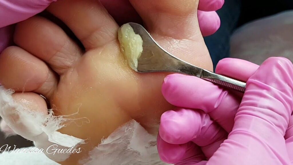 👣 Curso de Plástica e Spá dos Pés - Remova Calos e Rachaduras